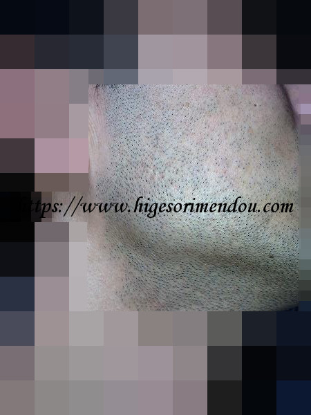 ケノンで髭脱毛を初めて約2か月経った髭の状態