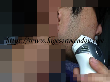 ケノンで髭脱毛を初めて約2か月経った髭の状態2