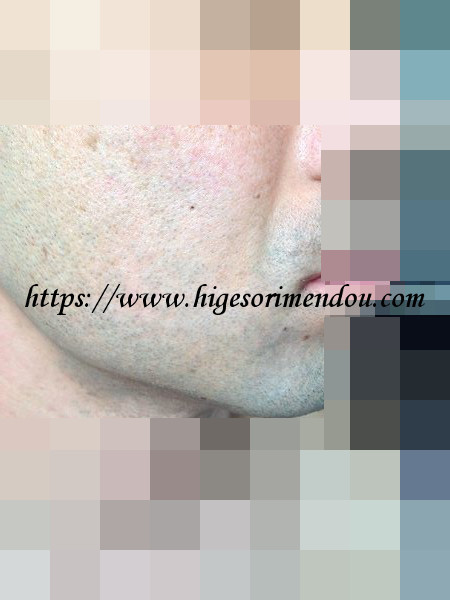 ケノンで髭脱毛を初めて約4か月経った髭の状態