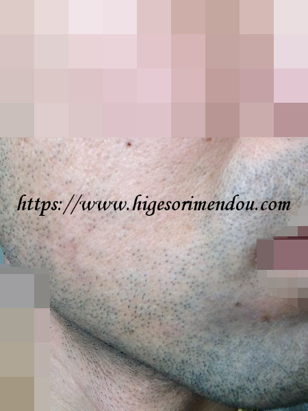 ケノンで髭脱毛を初めて約12か月経った髭の状態