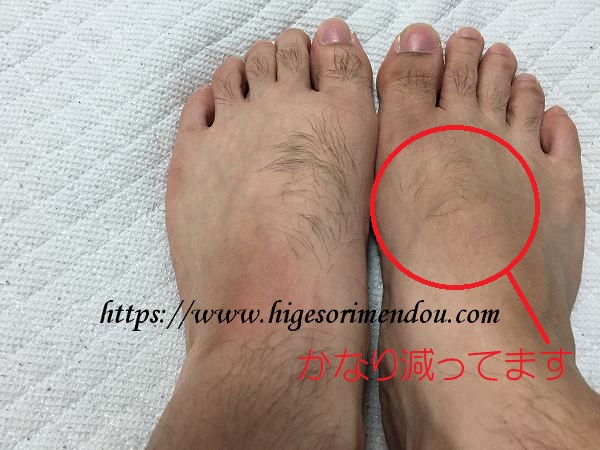 ケノンで足の甲の脱毛6か月後の状態