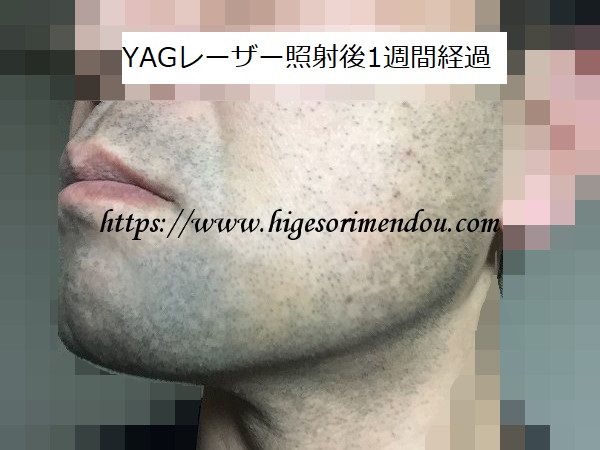 YAGレーザー照射後1週間