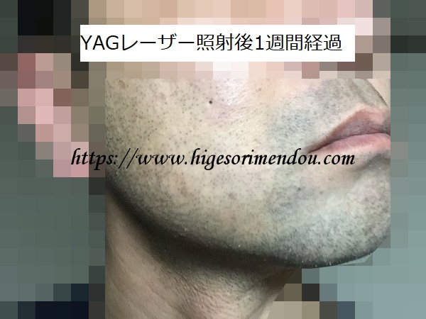 YAGレーザー照射後1週間