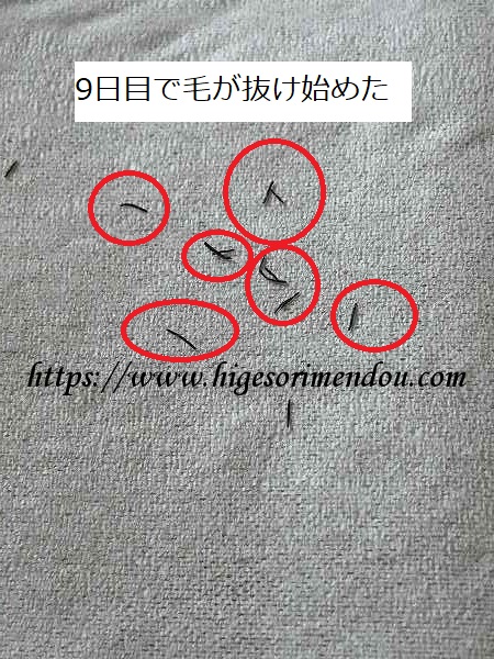 YAGレーザー照射後9日目で毛が抜ける
